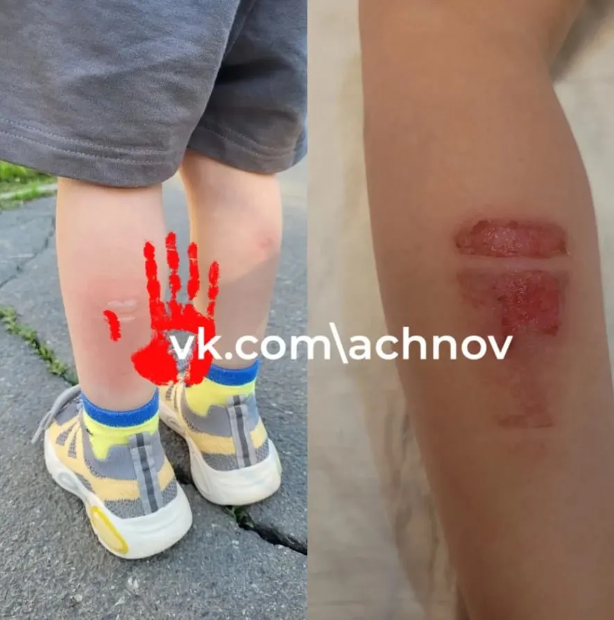 Инцидент произошёл 18 мая в автобусе №2: трёхлетний мальчик получил ожог ноги. Следователи начали проверку и затребовали у перевозчика документы по техническому состоянию транспорта.