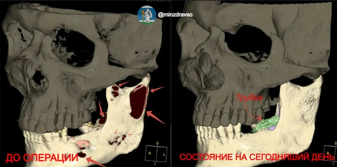 Гигантская киста от коренных зубов до височно‑нижнечелюстного сустава вызвала воспаление и истончение кости. Врачи провели малоинвазивную операцию — полное восстановление займёт около двух лет.
